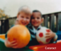 Cataract Surgery | Intraocular Lens Paramus NJ | Hackensack NJ