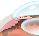 SLT Procedure | Glaucoma Treatment Paramus NJ | Hackensack NJ
