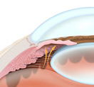 SLT Procedure | Glaucoma Treatment Paramus NJ | Hackensack NJ