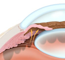 SLT Procedure | Glaucoma Treatment Paramus NJ | Hackensack NJ