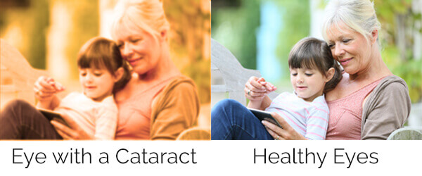 Chart showing vision with a healthy eye compared to one with a cataract