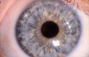 Closeup of an Eye That has Had a Corneal Transplant