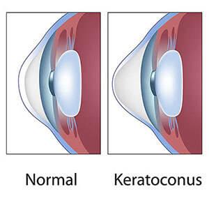 Chart Showing a Normal Eye Compared to One With Keratoconus