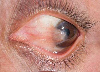 Pterygium Example