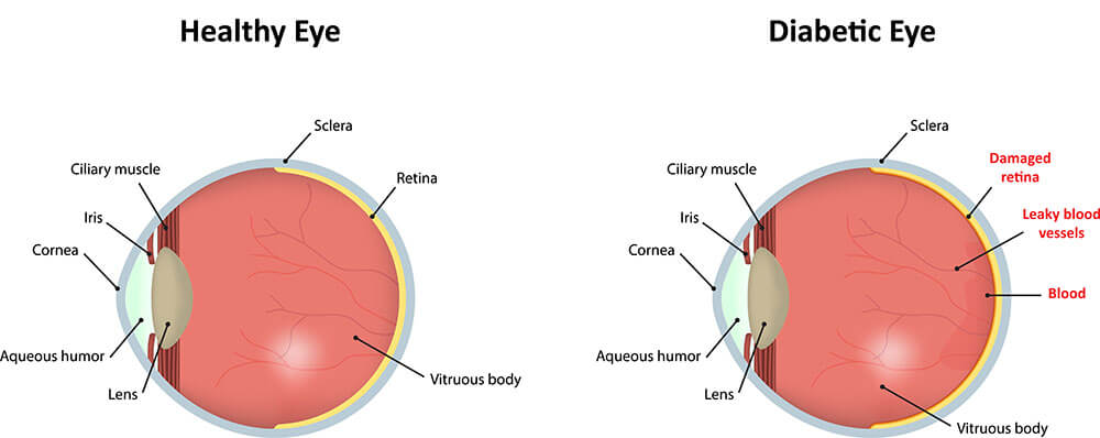 Diabetic Retinopathy Diagram