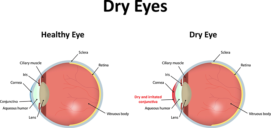 Dry Eyes Paramus