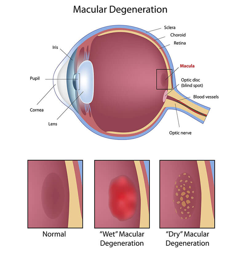 Chart Showing Macular Degeneration Types