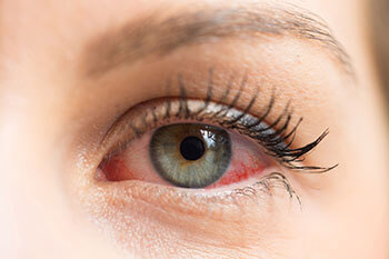Woman's eye affected by Dry Eye Syndrome