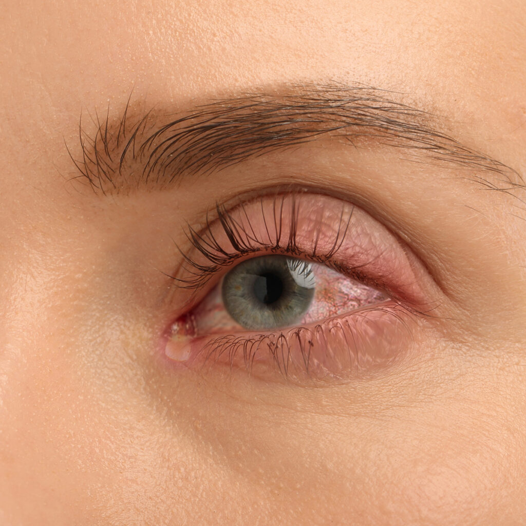 Close-up of an eye with red, irritated eyelid margins